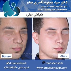 جراحی بینی مردانه توسط دکتر مسعود ناصری صدر